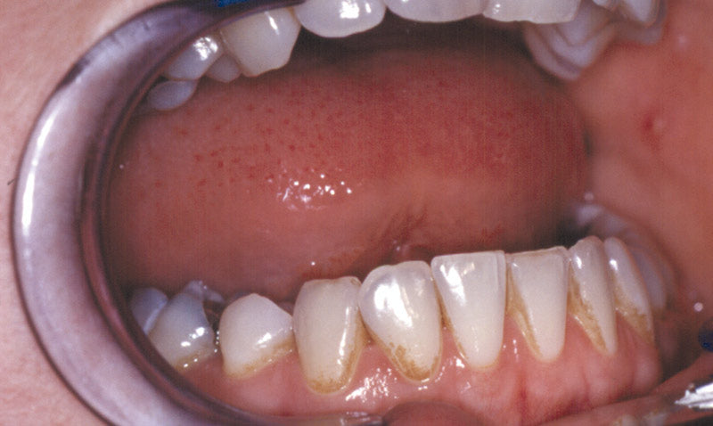 Zahnradierer mit Zahnsteinentferner 11 cm Edelstahl