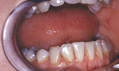 Zahnradierer mit Zahnsteinentferner 11 cm Edelstahl