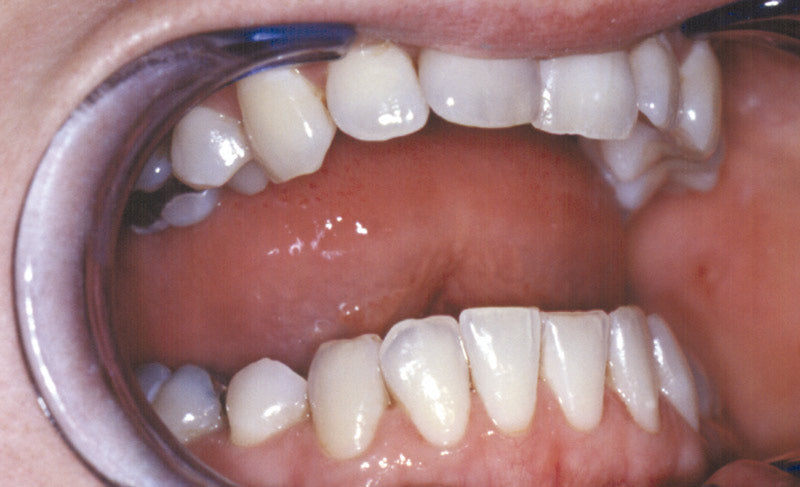 Zahnradierer mit Zahnsteinentferner 11 cm Edelstahl