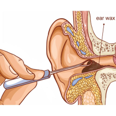 Ear Wax Remover made of stainless steel