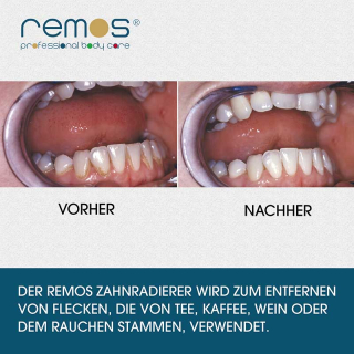 remos tooth discolouration eraser