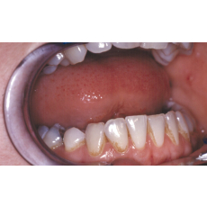 Zahnradierer mit Zahnsteinentferner 11 cm Edelstahl