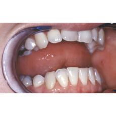 Zahnradierer mit Zahnsteinentferner 11 cm Edelstahl