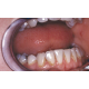 tooth discolouration eraser + plaque remover