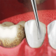tooth discolouration eraser + plaque remover Set
